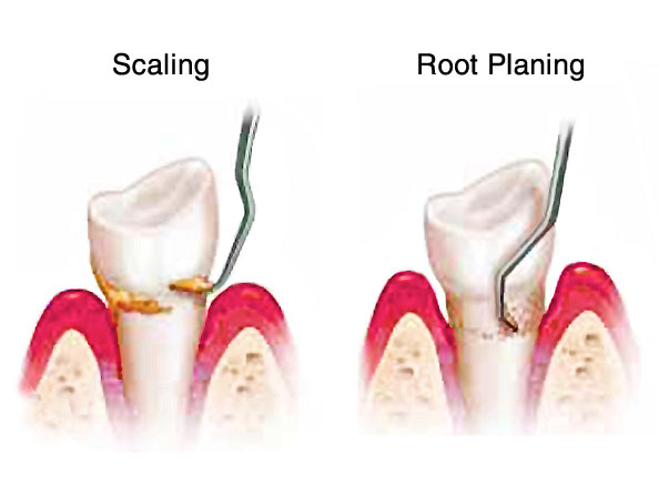 scaling root planing before and stains